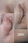 Удаления пигментного невуса (доброкачественного образования кожи)