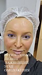 Ретиноловый пилинг